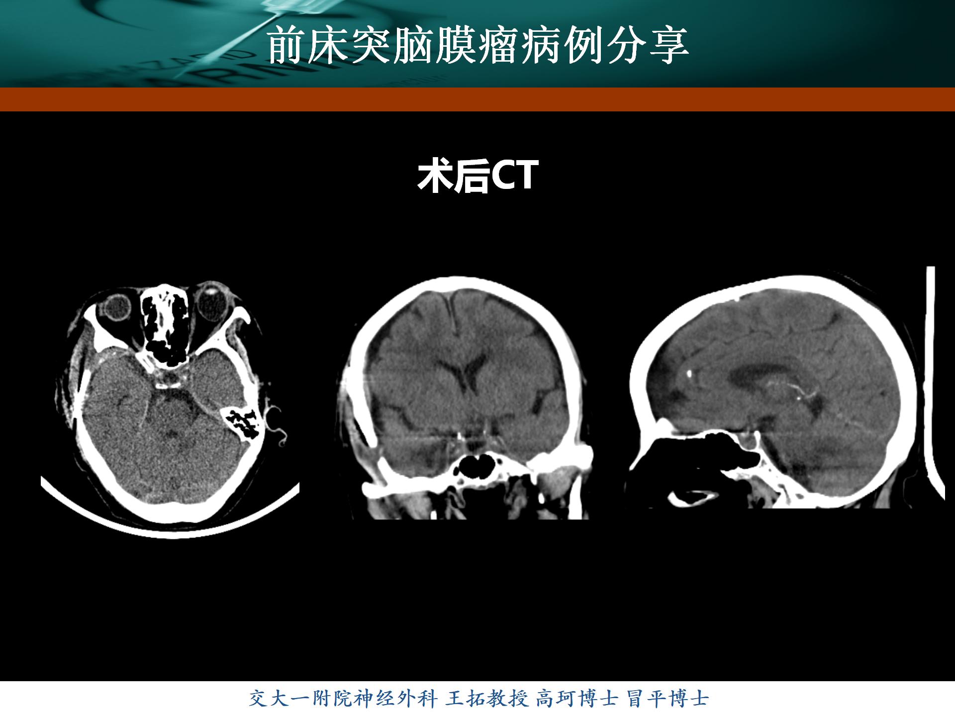 贺晓生教授：右侧矢状窦旁、镰旁脑膜瘤切除（实例） - 微医（挂号网）