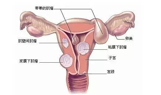 子宫肌瘤的生长部位.jpg