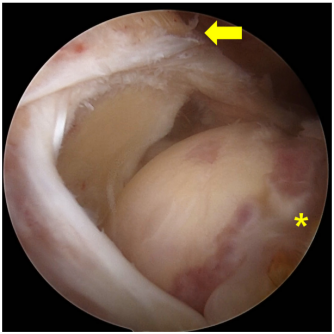 巨大不可修复性上关节囊重建新选择--脱细胞真皮基质同种异体移植物联合残余肌腱加强