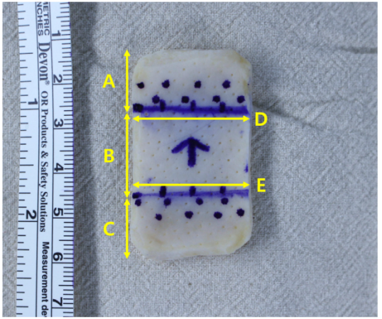 巨大不可修复性上关节囊重建新选择--脱细胞真皮基质同种异体移植物联合残余肌腱加强