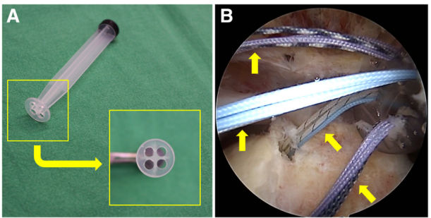 巨大不可修复性上关节囊重建新选择--脱细胞真皮基质同种异体移植物联合残余肌腱加强