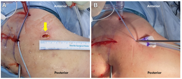 巨大不可修复性上关节囊重建新选择--脱细胞真皮基质同种异体移植物联合残余肌腱加强