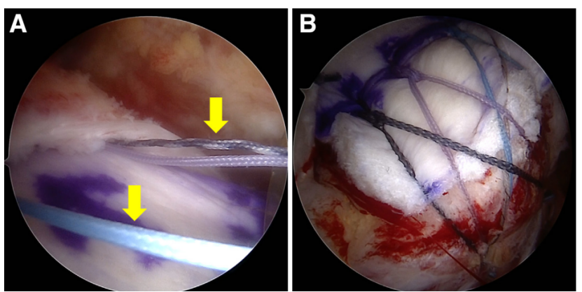 巨大不可修复性上关节囊重建新选择--脱细胞真皮基质同种异体移植物联合残余肌腱加强