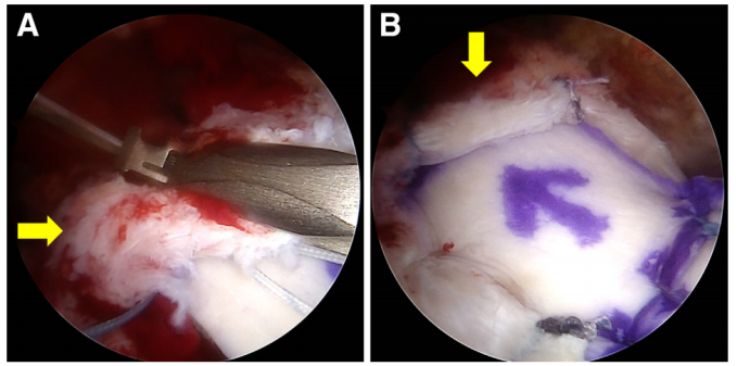 巨大不可修复性上关节囊重建新选择--脱细胞真皮基质同种异体移植物联合残余肌腱加强