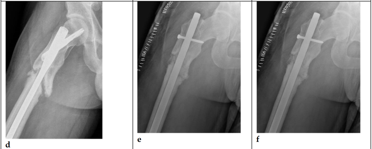 关于防止股骨转子间骨折不愈合的当前治疗理念