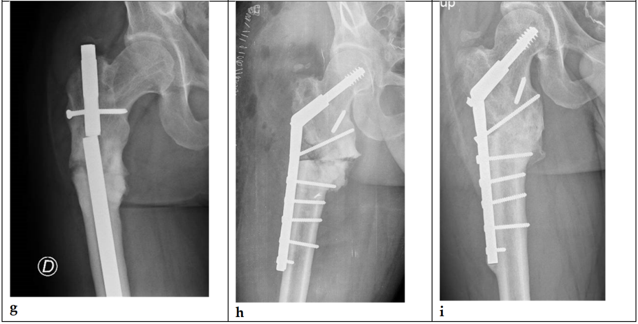 关于防止股骨转子间骨折不愈合的当前治疗理念